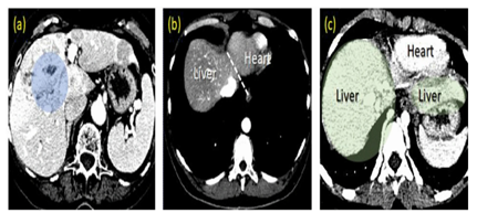 Issues related to liver division, i.e., in-homogeneity of force in the liver area (a), the fluffy partition among liver & heart (b), & the multi-portions calculation inside a solitary slide (c). Likewise, these cases show different power scopes of liver challenges.