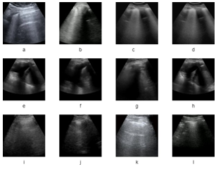 Sample lung ultrasound images obtained from POCUS dataset [4, 5, 6]. The first, second and third row represent COVID-19, Pneumonia and normal images, respectively