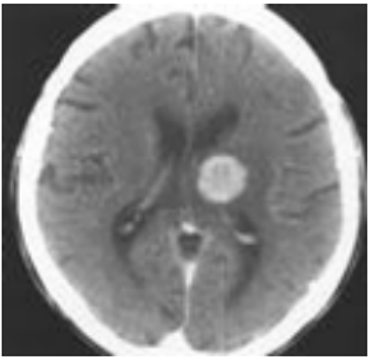 Input sample CT scan brain image