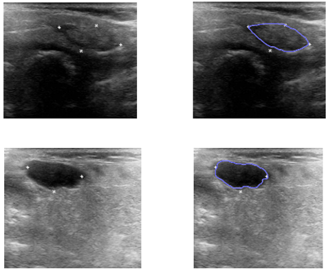 Benign thyroid lesions and their delineations