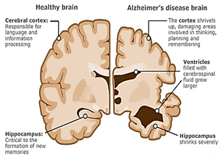 Anatomy of Healthy and Alzheimer’s Brain