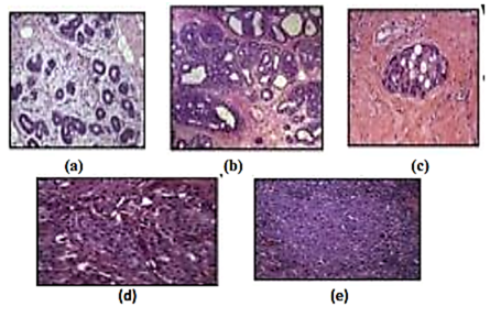 Breast Cancer at Different Stages:(a) Normal-Breast, (b) Breast Hyper-plasia, (c) Ductal Carcinoma-In-Situ, (d) Invasive -Ductal Carcinoma, (e) Metastatic Disease