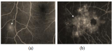 Figures showing two different retinal diseases with focal leakages.(a) malarial retinopathy (b) glaucomatic retinopathy