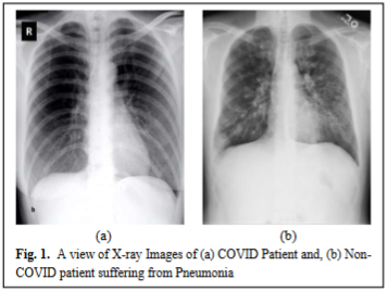 A view of X-ray Images of (a) COVID Patient and, (b) Non-COVID patient suffering from Pneumonia