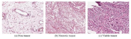 Classes of Bone Tumor using Histopathological Image