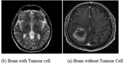 Images of brain with and without Tumour cell
