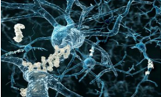 Neurons in the brain display microscopic plaques and tangles in Alzheimer's illness