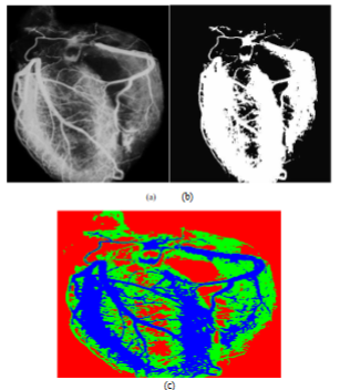 (a) Cardiac coronary angiography (original image) (b) Segmentation based on Standard Fuzzy C-means (c) Segmentation based on proposed method