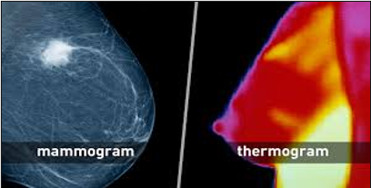 Breast Cancer mammogram and thermogram image (Yamini Ranchod, (2020))